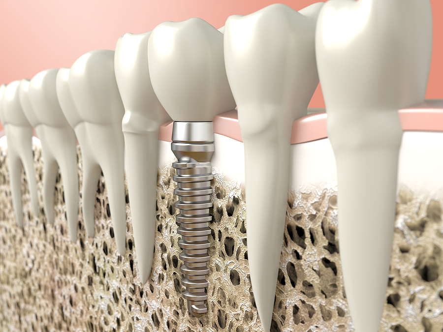 A Comprehensive Guide to Dental Implants: Benefits, Procedure, and Aftercare
