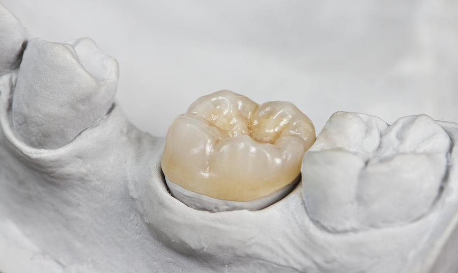 Restoring Your Smile: The Benefits of Dental Inlays and Onlays