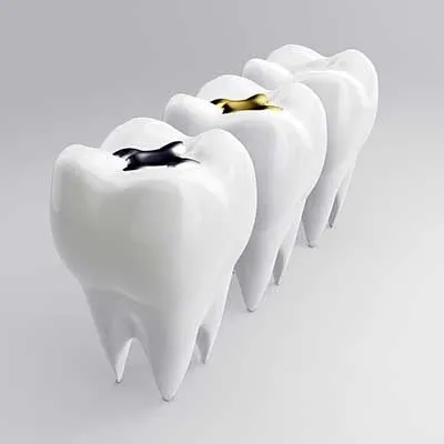 Dentistry Spanish Fork UT Dental Fillings Dummy Model