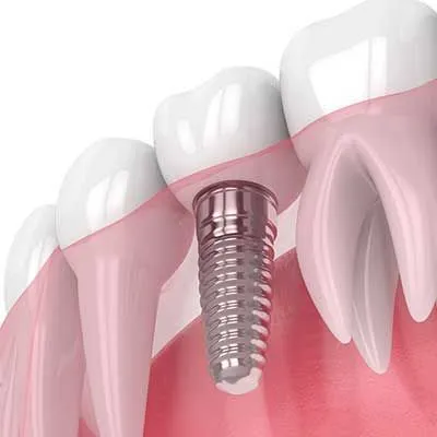 Dentistry Spanish Fork UT Dental Implants Vector Image