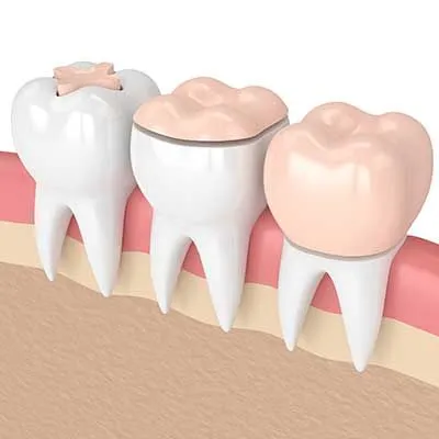 Dentistry Spanish Fork UT Dental Inlays and Onlays Dummy Model