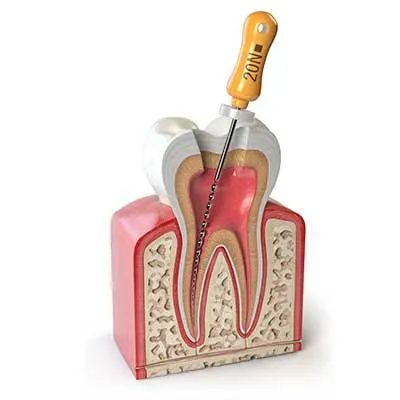 Dentistry Spanish Fork UT Root Canal Education Model